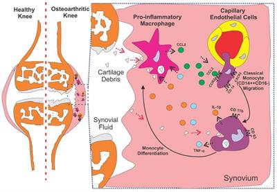 Typical response of CD14++CD16– monocyte to knee synovial derived mediators as a key target to overcome the onset and progression of osteoarthritis